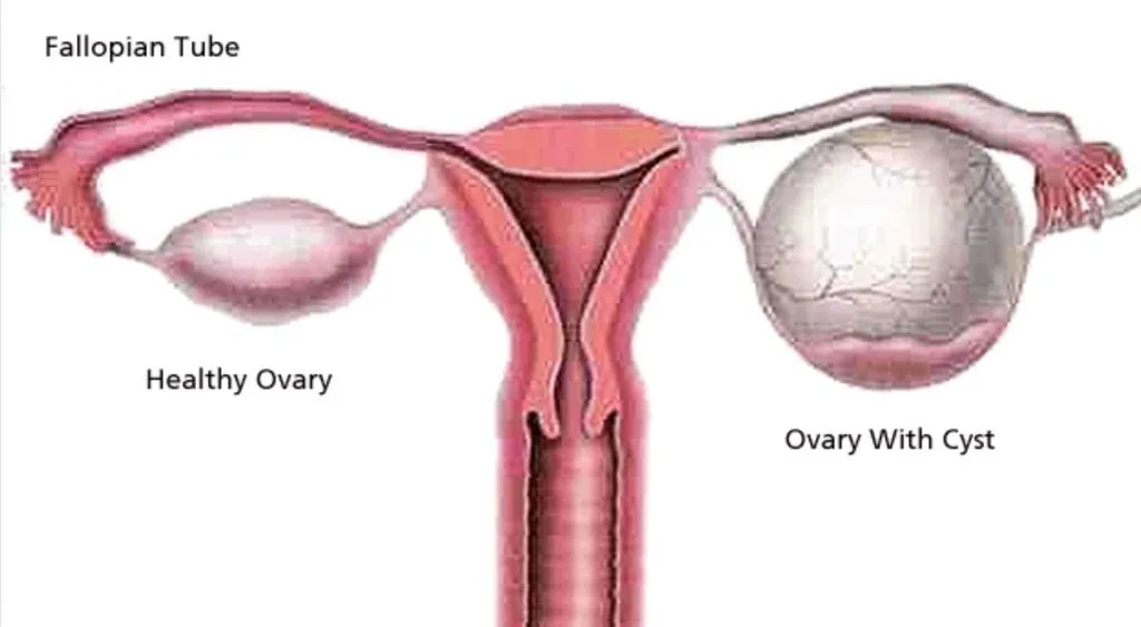 Using natural remedies to treat female ovarian cysts